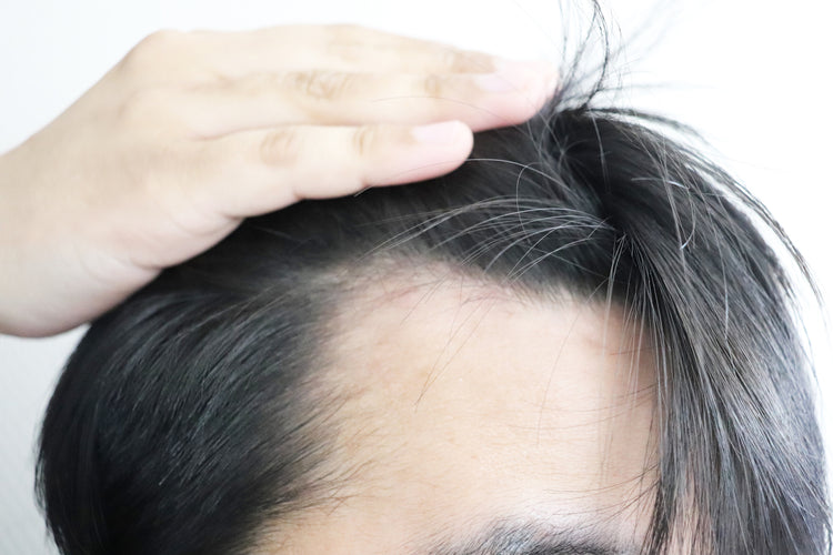 前髪から進行するAGAの特徴とは？おでこの生え際・前髪が薄くなってきた男性必見